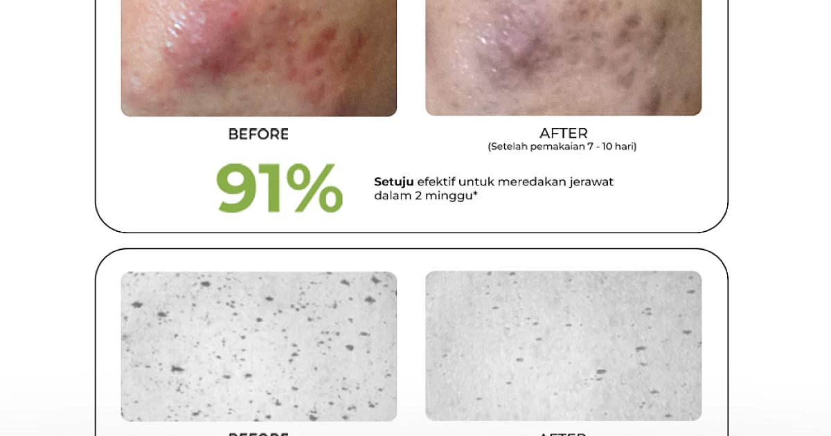 Cara Atasi Kulit Kusam & Bekas Jerawat dengan Set 3in1
